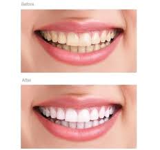 TEETH WHITENING  Edgware